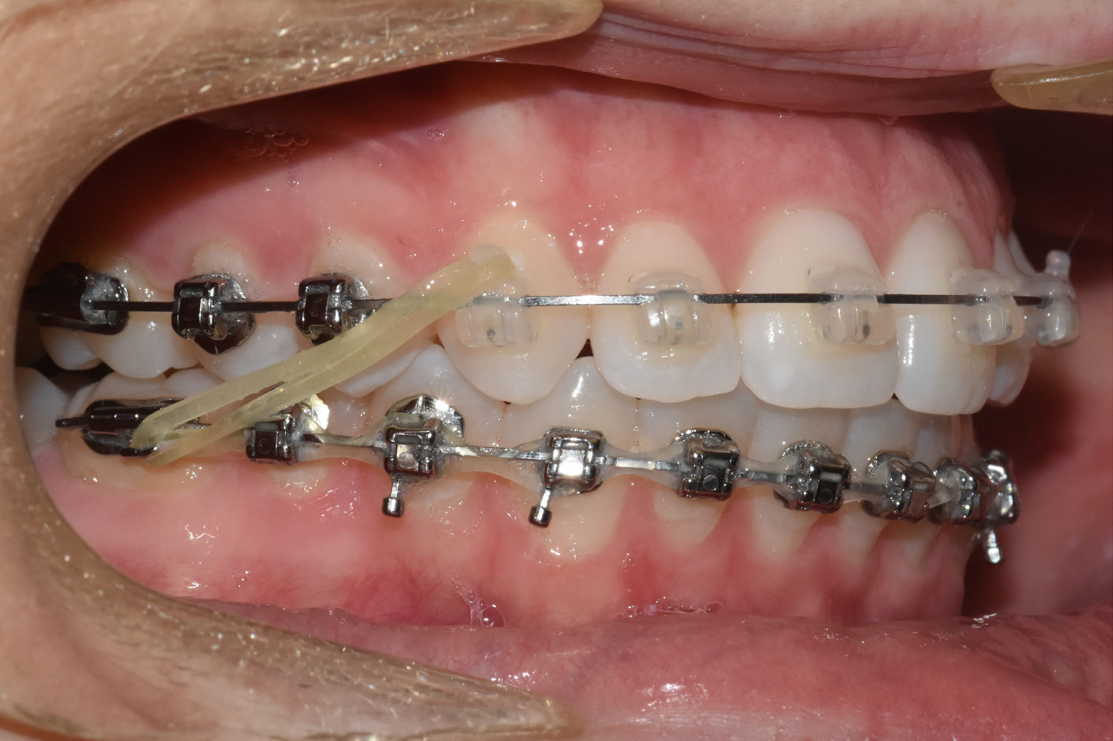 How Do Rubber Bands Work For Orthodontic Braces? - Hillsdale Orthodontics